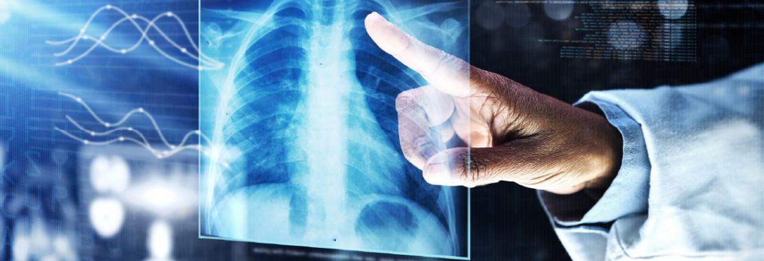 FDA Advisory Committee reviewed Imfinzi for treatment of resectable non-small cell lung cancer based on AEGEAN Phase III trial results