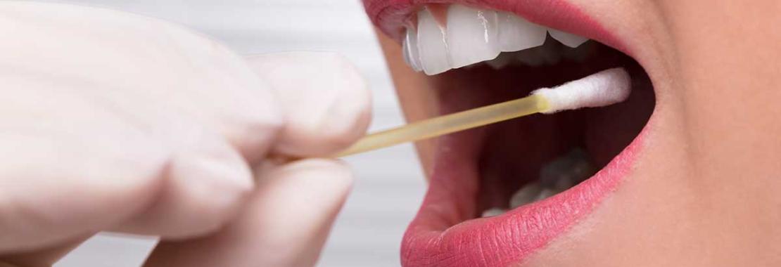 Tumore orofaringeo da Hpv: messo a punto un test salivare per la diagnosi precoce