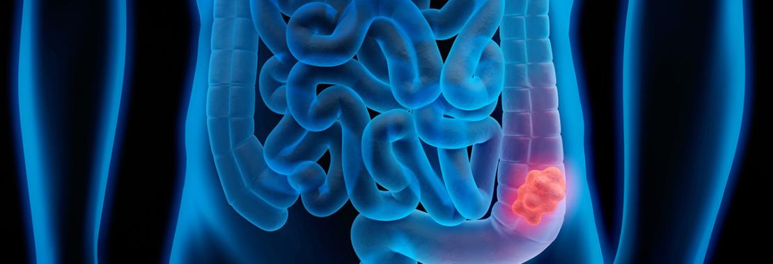 Le mutazioni del Dna che mettono il “turbo” al cancro: un nuovo parametro per valutare l’aggressività della malattia