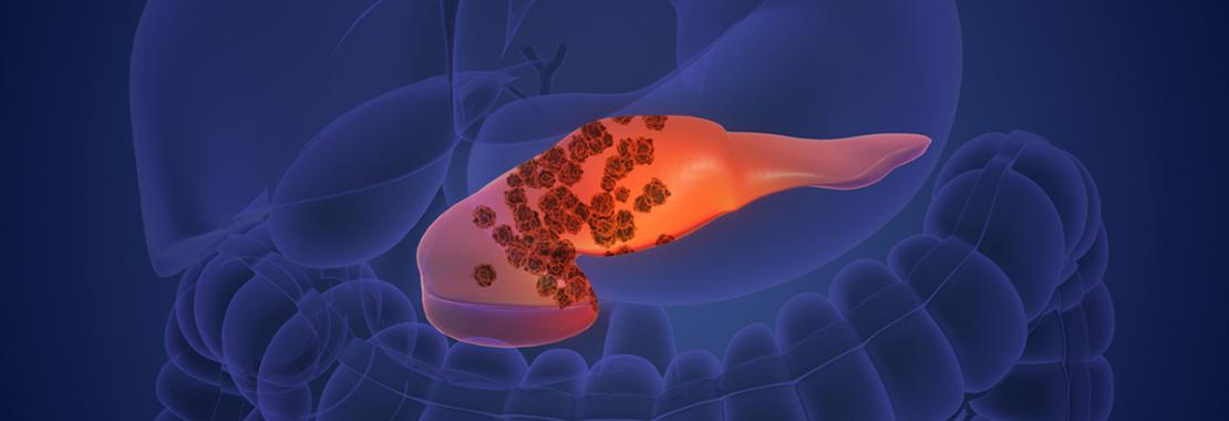 Cancro al pancreas: vaccino terapeutico elimina la malattia nei modelli preclinici