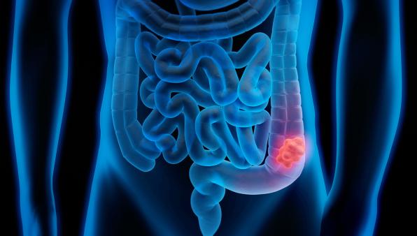 Le mutazioni del Dna che mettono il “turbo” al cancro: un nuovo parametro per valutare l’aggressività della malattia