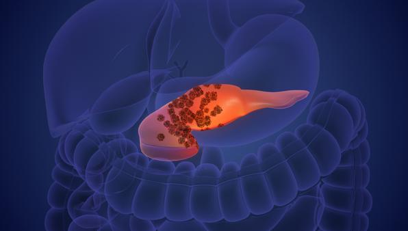 Cancro al pancreas: vaccino terapeutico elimina la malattia nei modelli preclinici